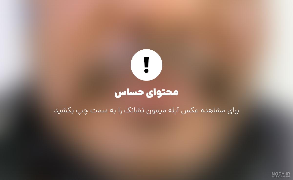 عکس آبله میمون در ایران