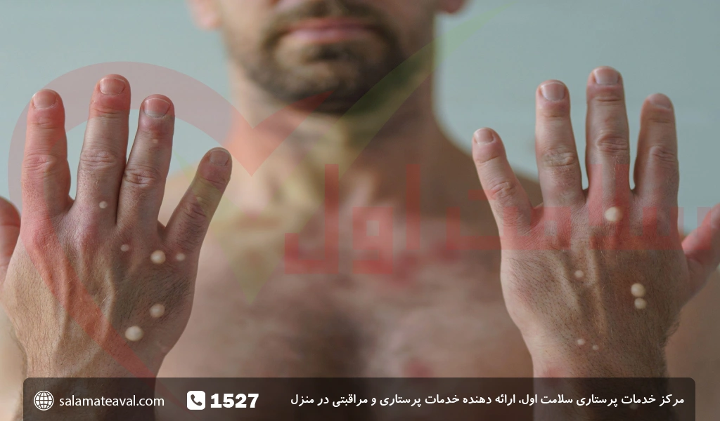 عکس جوش ابله میمونی