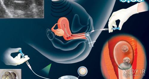 راهی برای به دست آوردن آرزوی شیرین شما/معرفی داروهای ای وی اف (IVF) راهی برای به دست آوردن آرزوی شیرین شما/معرفی داروهای ای وی اف (IVF)