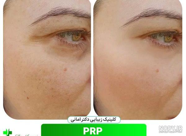 عکس قبل و بعد پی آر پی صورت عکس قبل و بعد پی آر پی صورت