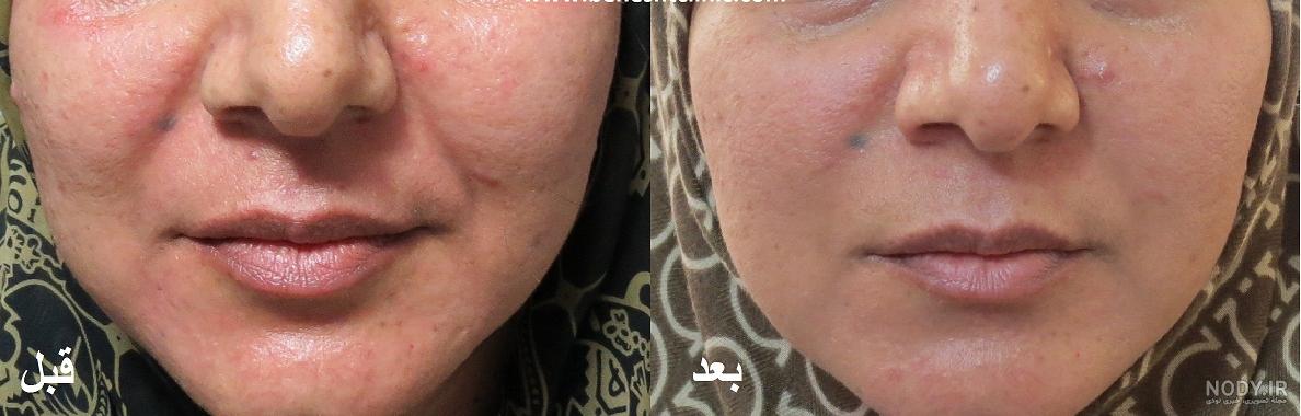 عکس پی ار پی زیر چشم عکس پی ار پی زیر چشم