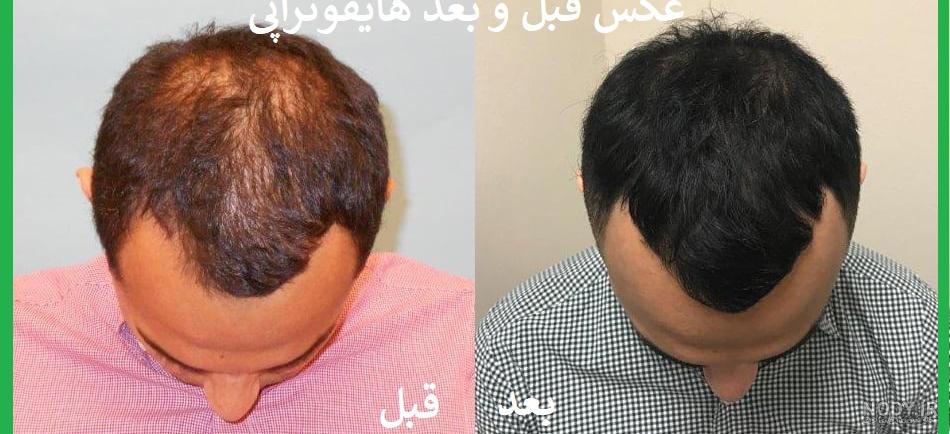 پی آر پی صورت، جهت شادابی پوست + عکس قبل و بعد از پی آر پی پی آر پی صورت، جهت شادابی پوست + عکس قبل و بعد از پی آر پی
