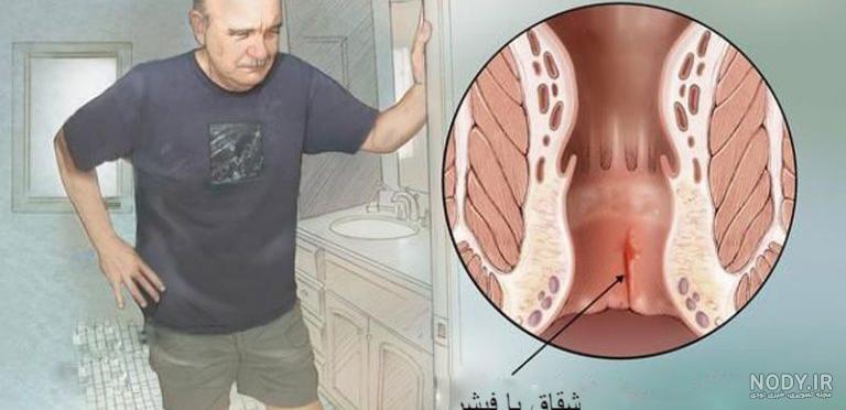 عمل بواسیر با تیغ جراحی هموروئید چگونه است[عکس قبل وبعدعمل] - پرتو کلینیک