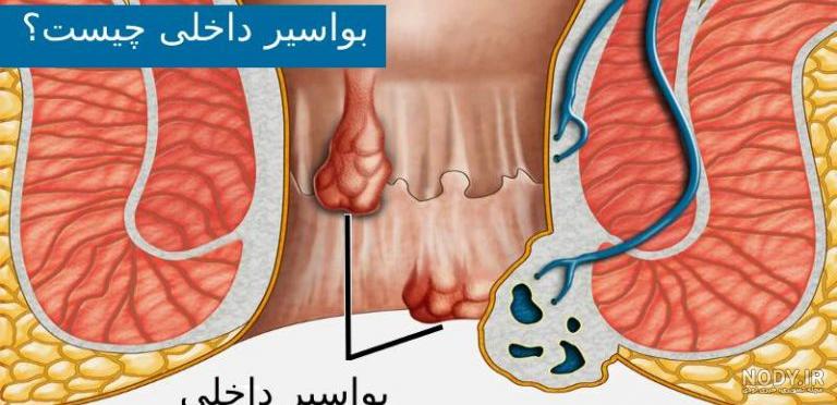 مشکلات رکتوم و روده بزرگ - دکتر مژده مقدسی متخصص بیماری های داخلی در کرج