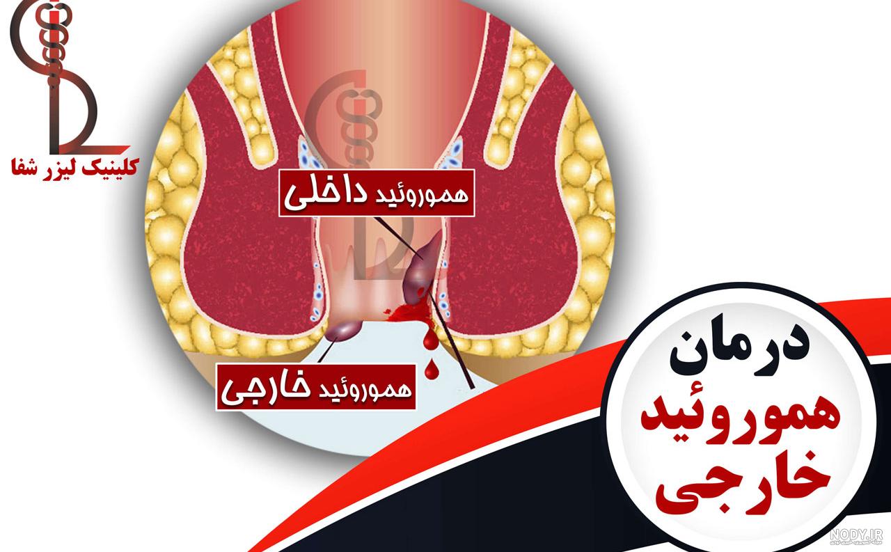 گالری {عکس شقاق مقعدی} خفیف و بیرون زده، تصویر شکل ظاهری زخم فیشر | درمان  تهران
