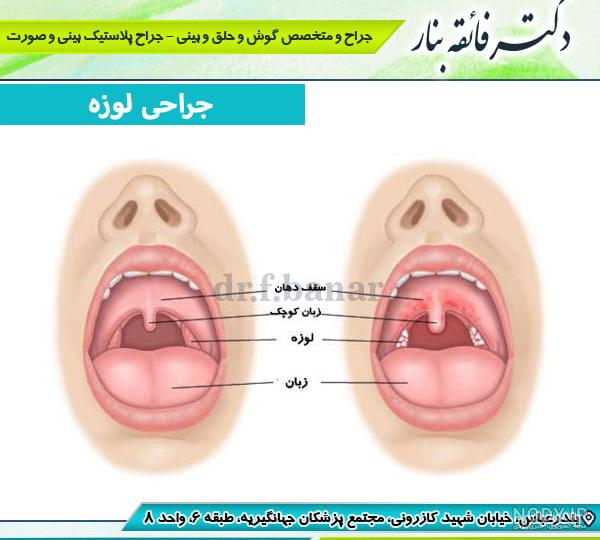 عکس لوزه سالم کودک