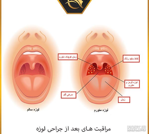 عکس لوزه طبیعی کودک