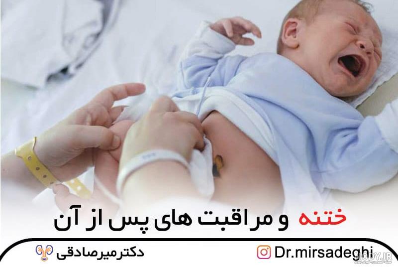 عکس ختنه مادرزادی