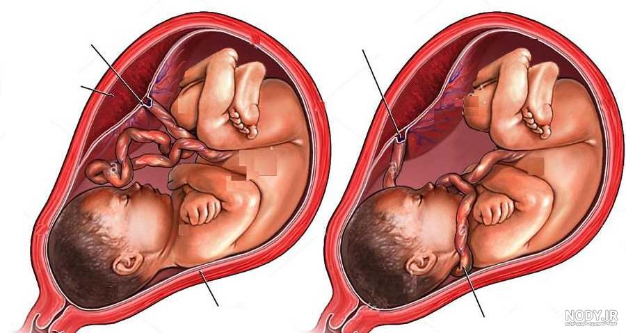 پیچیدن بند ناف جنین به دور گردن | علت، عوارض و نحوه تشخیص | دکتر مرتضی  جورابیان