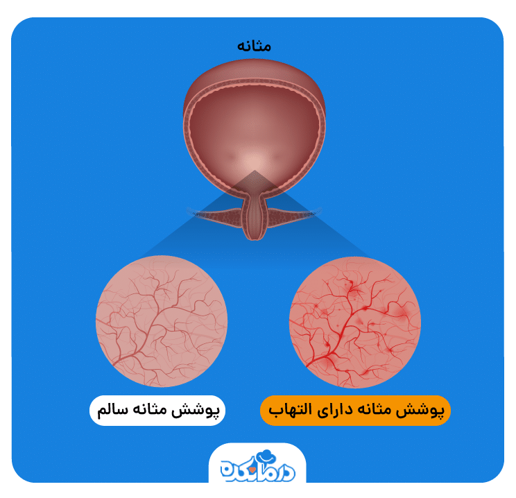 عکس مثانه سالم