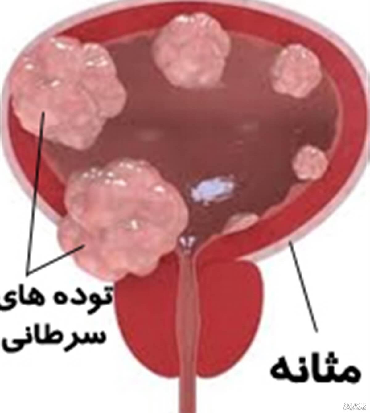 عکس مثانه مرد