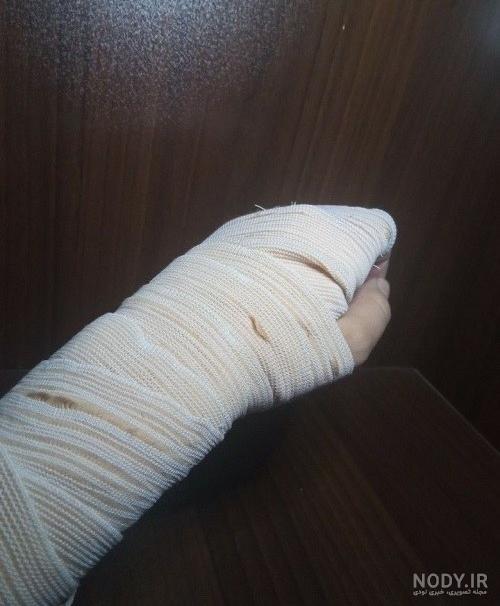 عکس از دست شکسته دختر