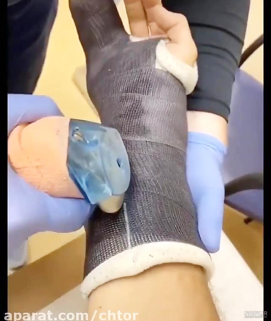 عکس دست شکسته دخترونه فیک
