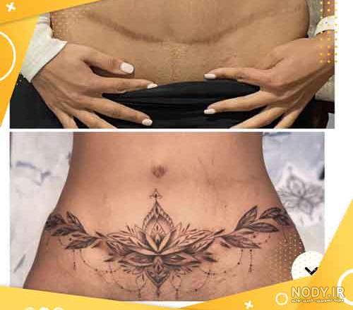 آشنایی با بهترین روش پاک کردن تاتو و از بین بردن خالکوبی | آفاطب