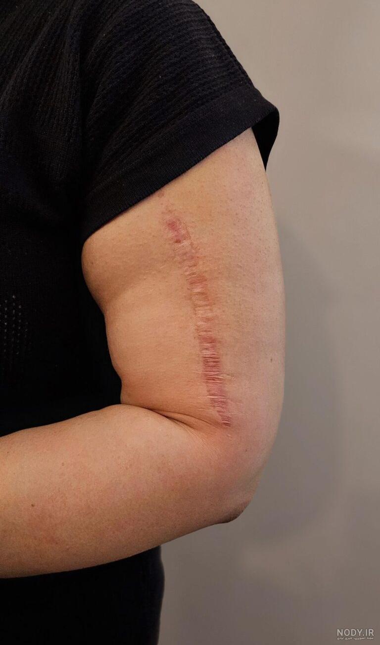 تاتو روی جای زخم دست