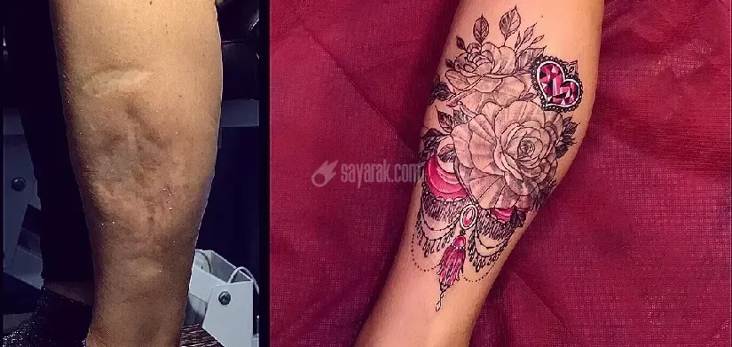 تاتو روی زخم و بخیه و چگونگی تتو روی زخم - دکتر تاتو