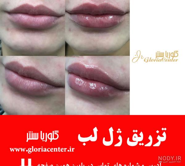 تزریق ژل لب با بهترین برندهای ژل و فیلر با قیمت مناسب 1403