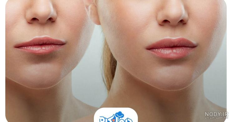 تزریق ژل لب طبیعی |دکتر فرشته جلالپور