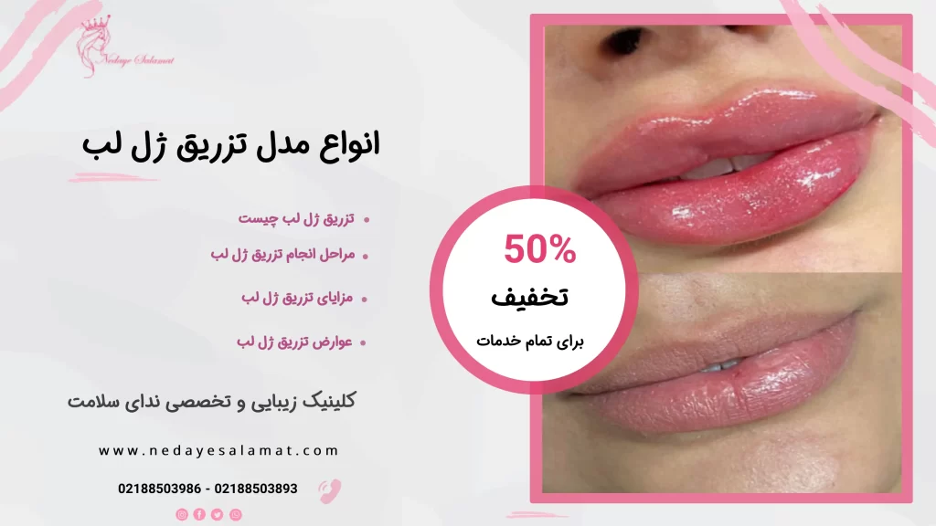عکس تزریق ژل لب - 10 نکته مهم در تزریق ژل لب - گلوریا سنتر