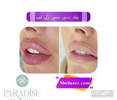 عکس روز اول تزریق ژل لب