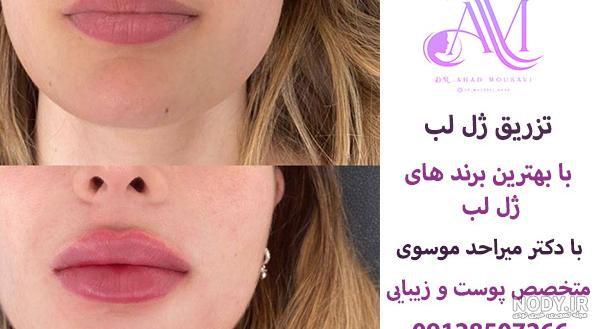 ژل لب چیست؟ عوارض و مزایا + مراحل تزریق و علت