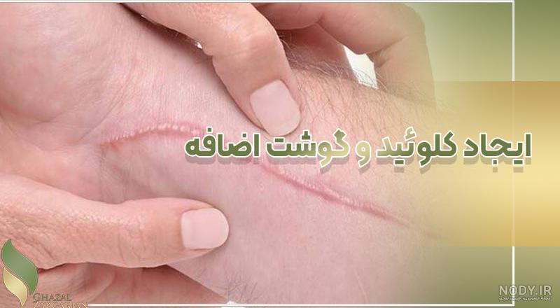 تاتو چه خطراتی در پی دارد و چگونه می توان آن را پاک کرد؟ - کلینیک جوان