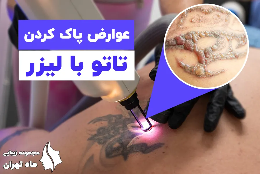 عوارض وحشتناک تتو - وبلاگ فروشگاه رپید تست