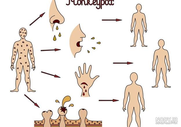 آبله میمون چیست و چقدر خطرناک است؟ آبله میمون چیست و چقدر خطرناک است؟