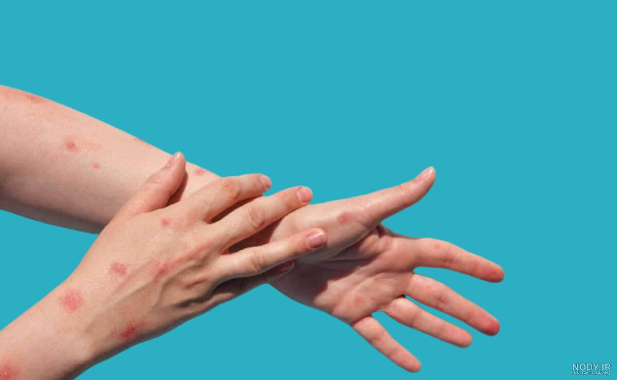 عکس آبله مرغان میمونی