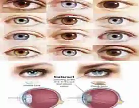 مراکز بینایی سنجی اهواز ( دقیق در تعیین نمره چشم)