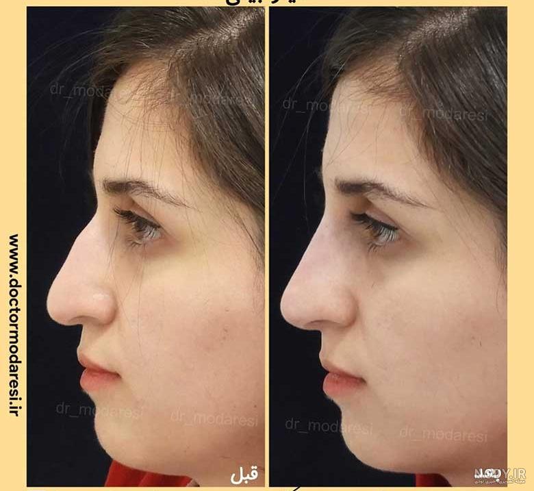 عکس های فیلر بینی