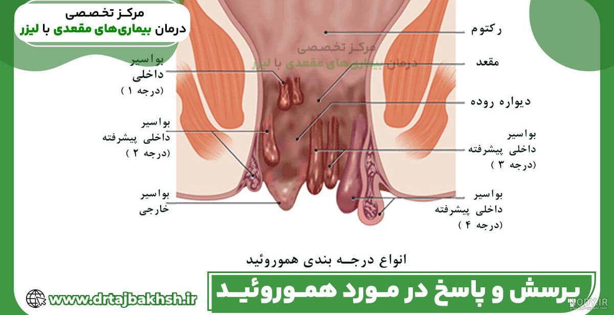 تزریق ژل باسن با هزینه آن و پاسخ به سوالات شما تزریق ژل باسن با هزینه آن و پاسخ به سوالات شما