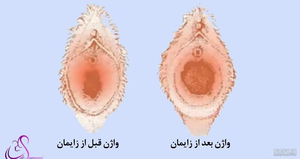 شکل واژن بعد از زایمان طبیعی + عکس - جراح و متخصص زنان، زایمان و نازایی -  دکتر فاطمه سمامی