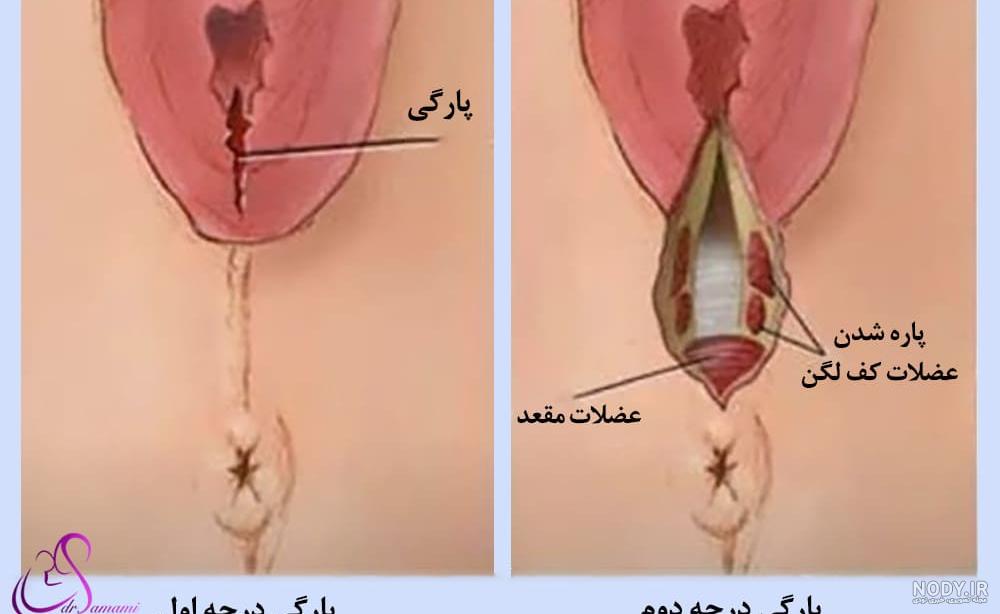 عکس پرینه واقعی
