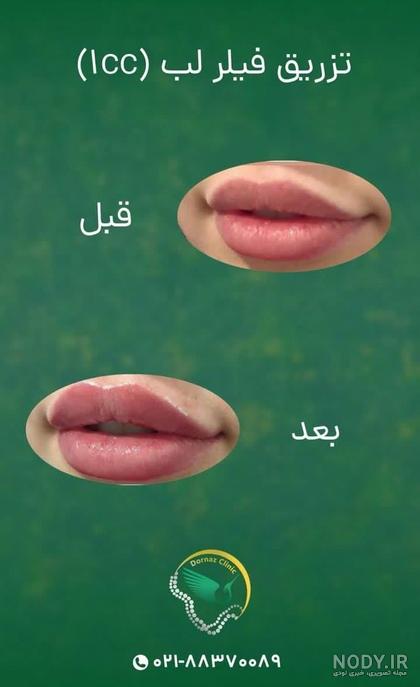 تزریق ژل لب | راهنمای 0 تا 100 [انواع ژل لب + مزایا و معایب]
