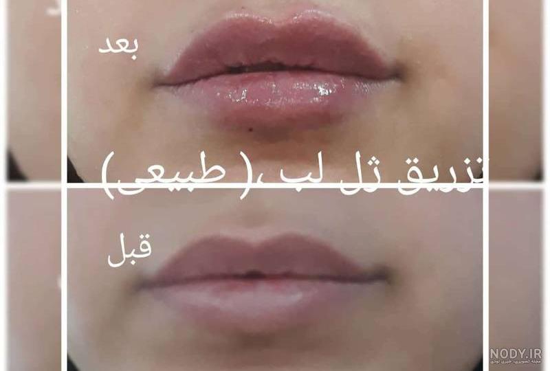 عکس تزریق ژل لب یک سی سی عکس تزریق ژل لب یک سی سی
