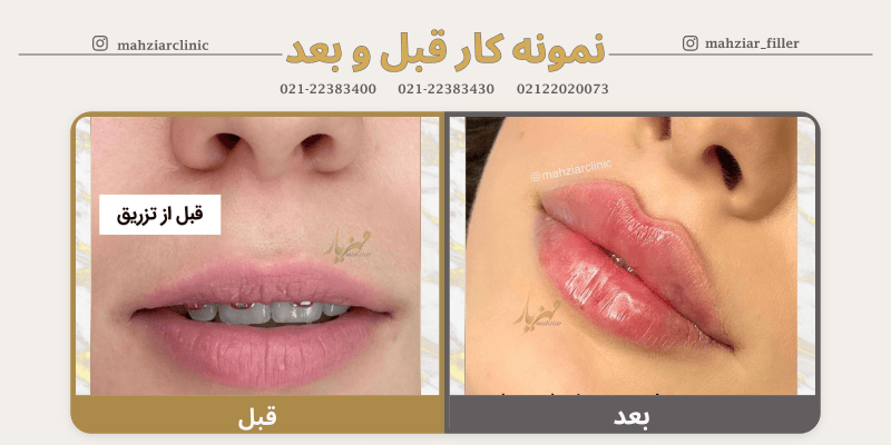 عکس قبل و بعد ژل لب نیم سی سی