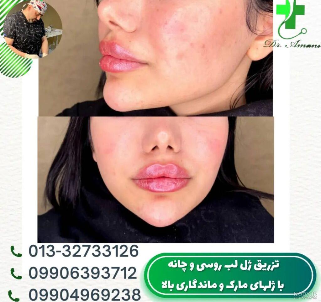 مراقبت های بعد از تزریق ژل لب مراقبت های بعد از تزریق ژل لب