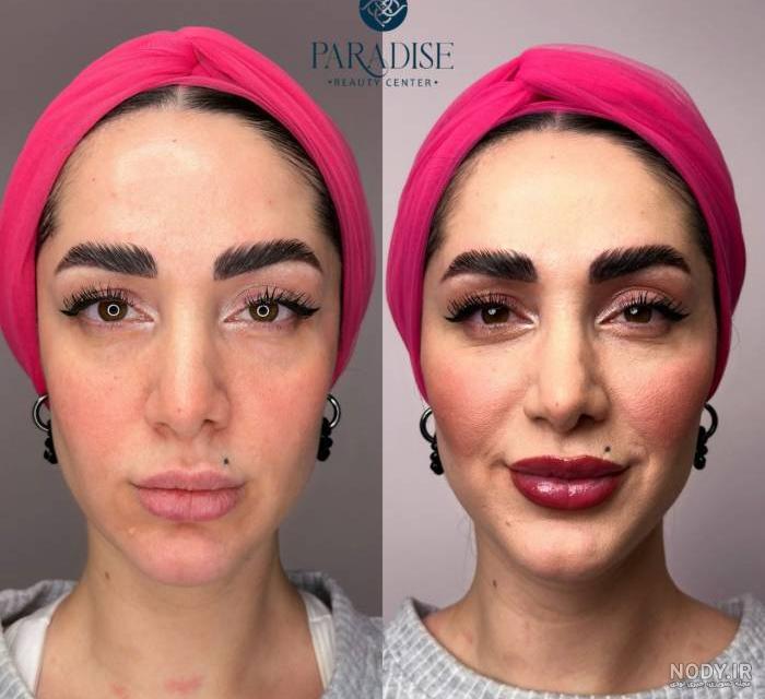 مقدار ژل مناسب برای لب : از نیم سی سی تا یک سی سی و بیشتر - مجله زیبایی مهرزاد مقدار ژل مناسب برای لب : از نیم سی سی تا یک سی سی و بیشتر - مجله زیبایی مهرزاد