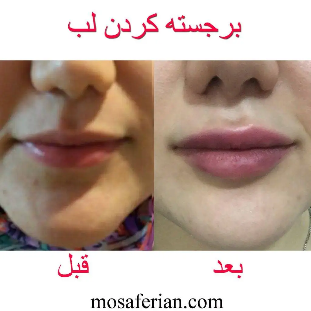 ژل لب طبیعی یا نچرال چیست؟ نحوه تزریق + ماندگاری و هزینه ژل لب طبیعی یا نچرال چیست؟ نحوه تزریق + ماندگاری و هزینه