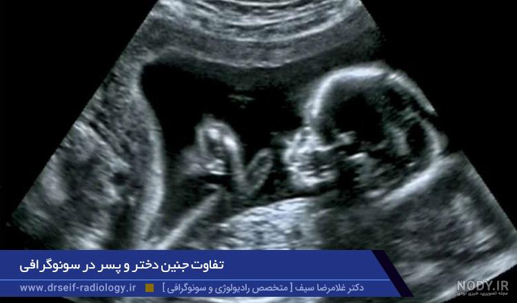 تشخیص جنسیت جنین از روی عکس و فیلم تشخیص جنسیت جنین از روی عکس و فیلم